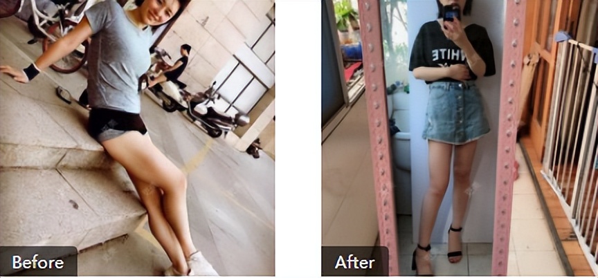 腿部吸脂术后效果_光子嫩肤术后护理_手臂粗做抽脂会反弹吗