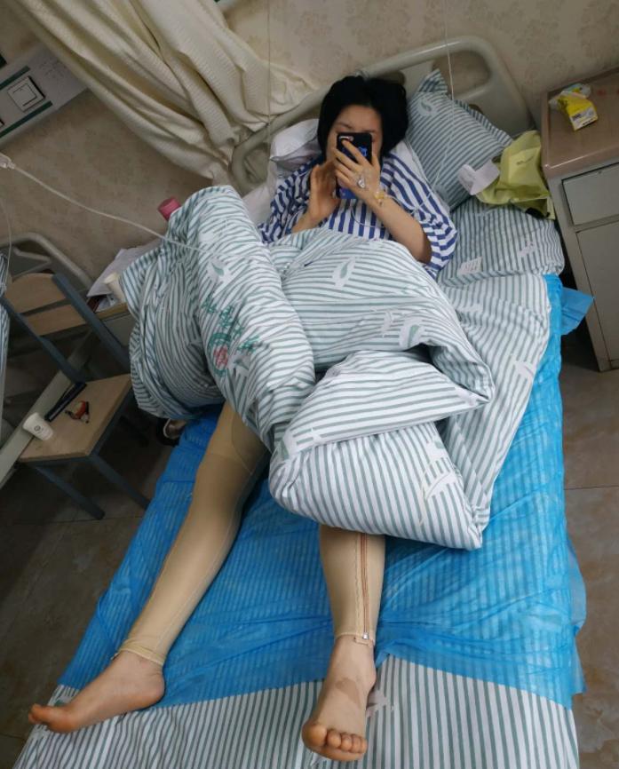 光子嫩肤术后护理_手臂粗做抽脂会反弹吗_腿部吸脂术后效果