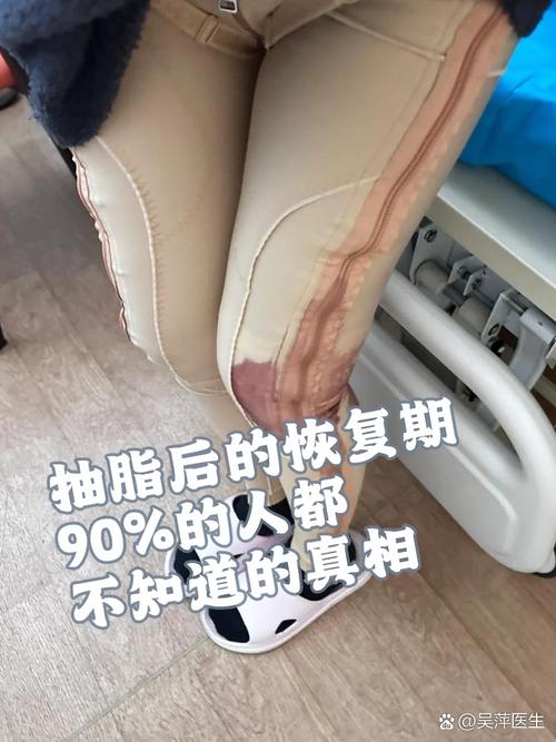 腿部吸脂术后效果_光子嫩肤术后护理_手臂粗做抽脂会反弹吗
