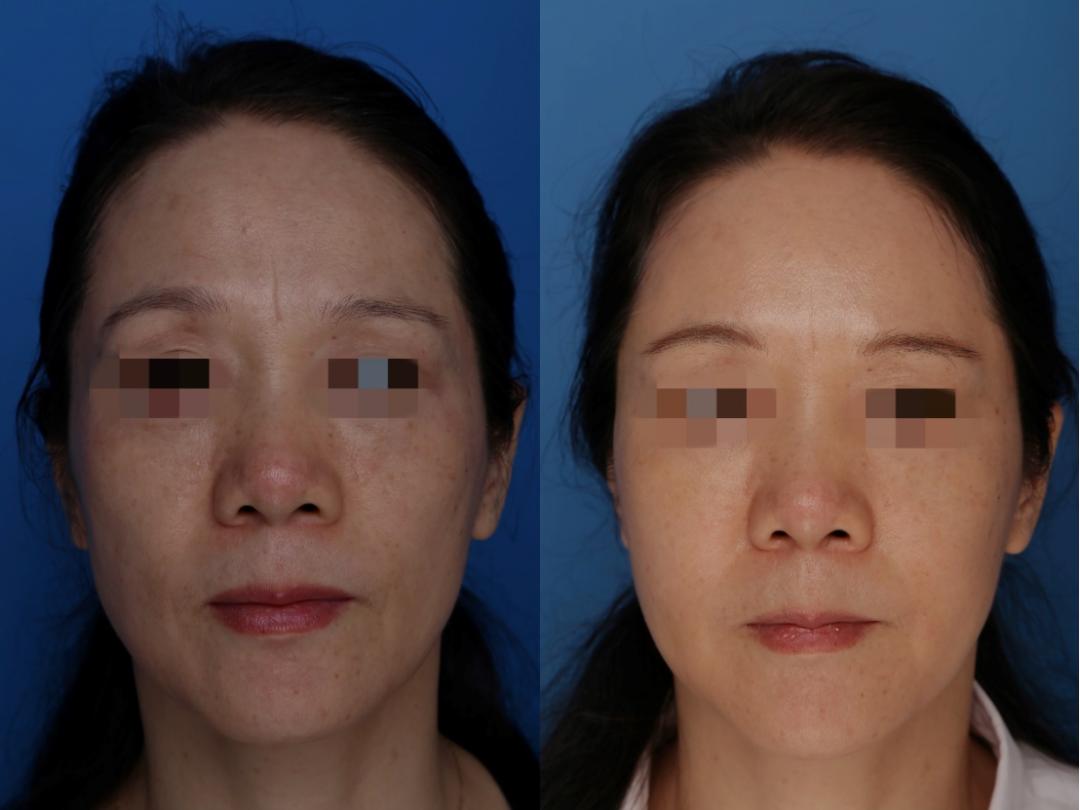 手臂粗做抽脂会反弹吗_抽脂手术适合人群_夏日减肥抽脂手术