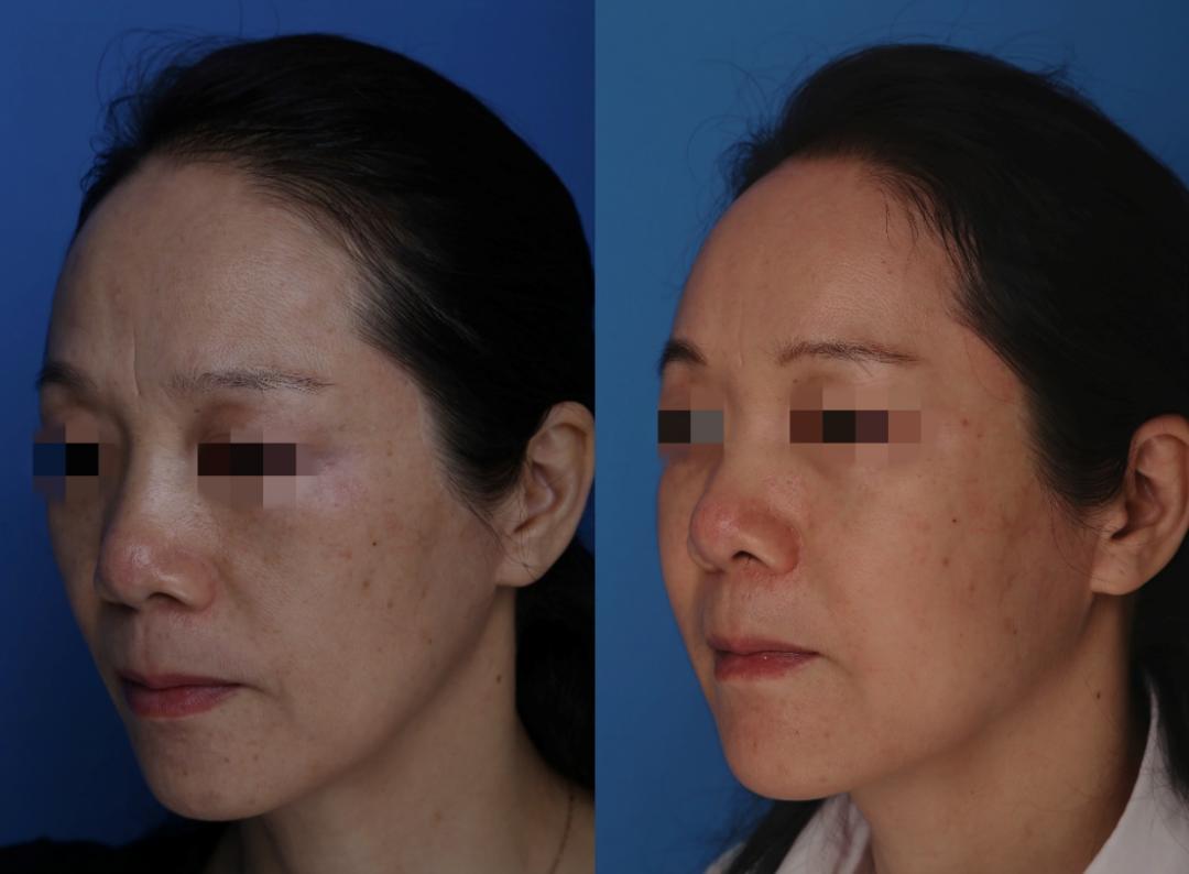 抽脂手术适合人群_手臂粗做抽脂会反弹吗_夏日减肥抽脂手术