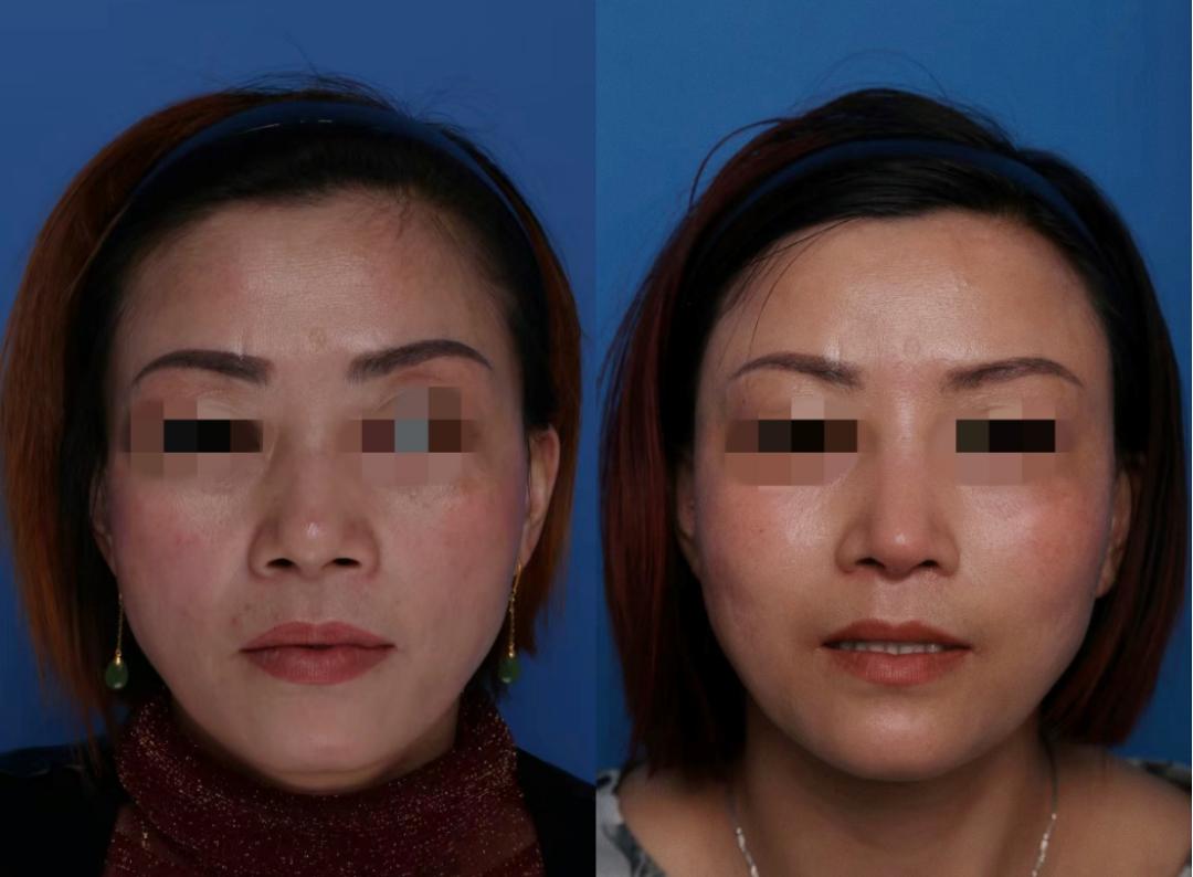 抽脂手术适合人群_夏日减肥抽脂手术_手臂粗做抽脂会反弹吗