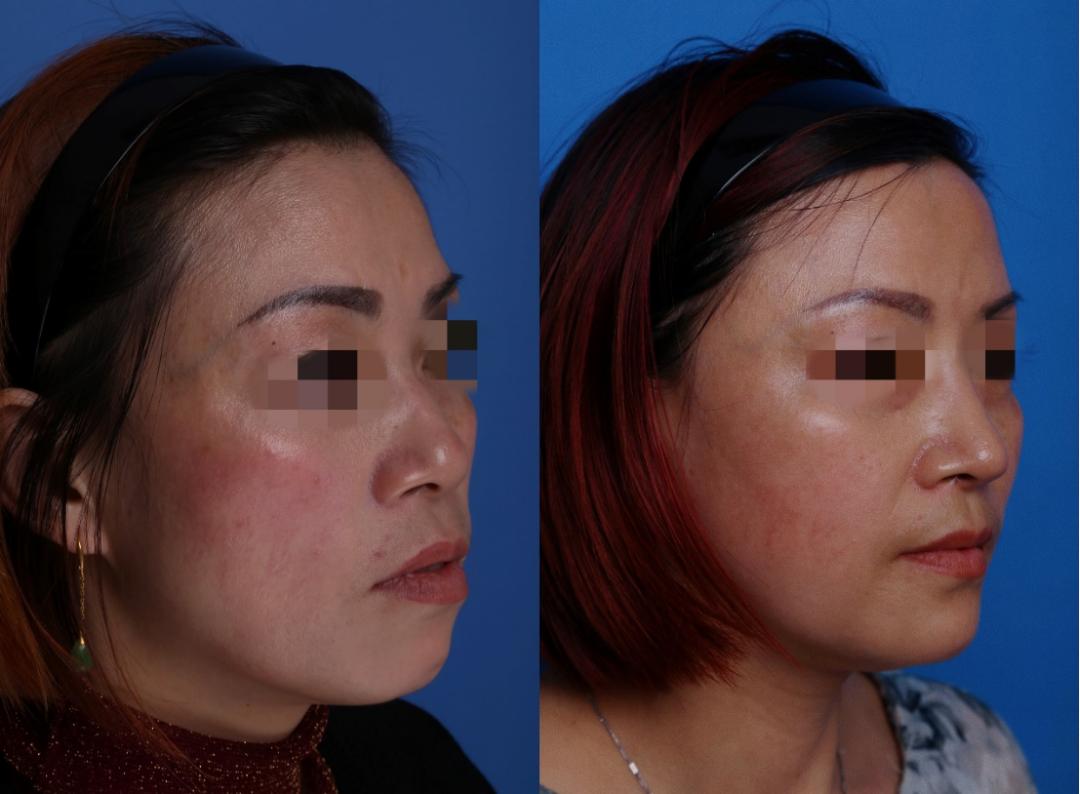 手臂粗做抽脂会反弹吗_夏日减肥抽脂手术_抽脂手术适合人群