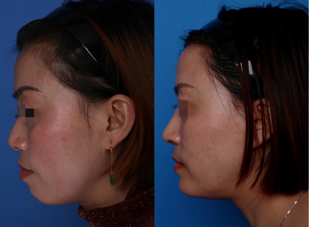 手臂粗做抽脂会反弹吗_抽脂手术适合人群_夏日减肥抽脂手术