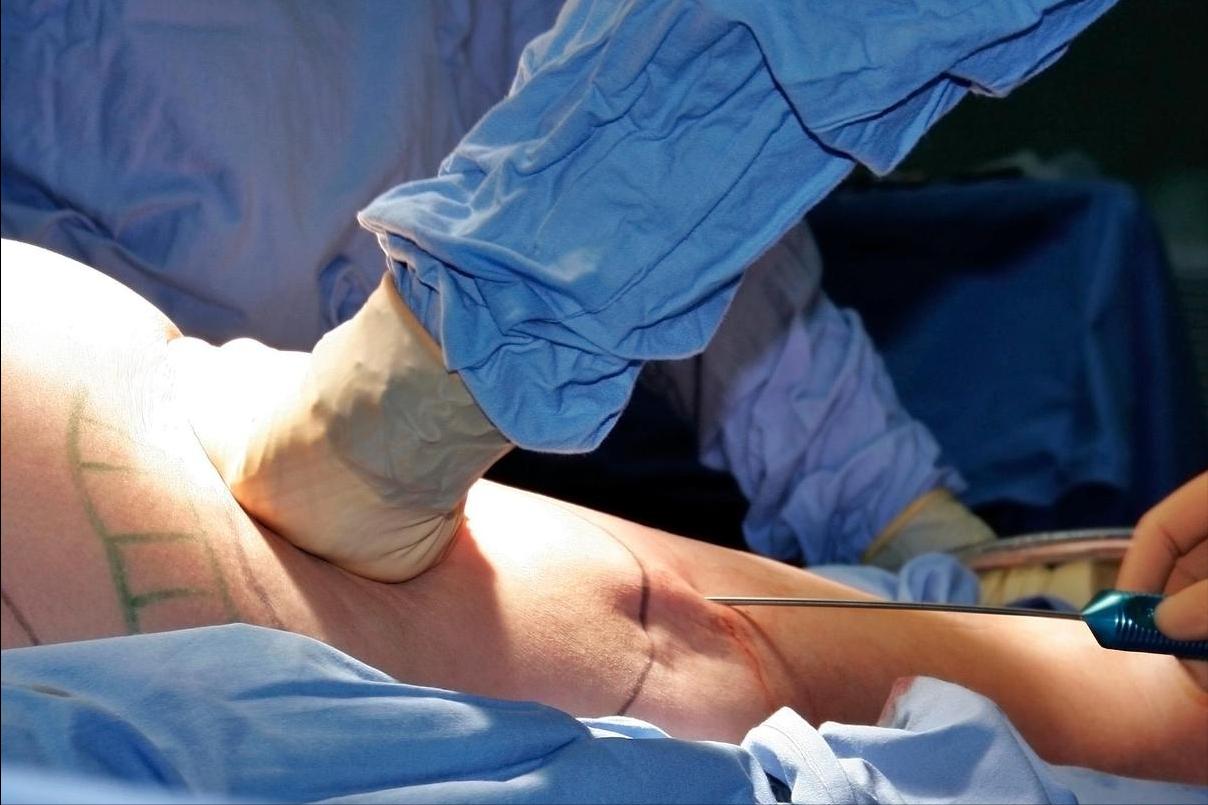 手臂粗做抽脂会反弹吗_抽脂减肥失败案例_产后减肥食谱