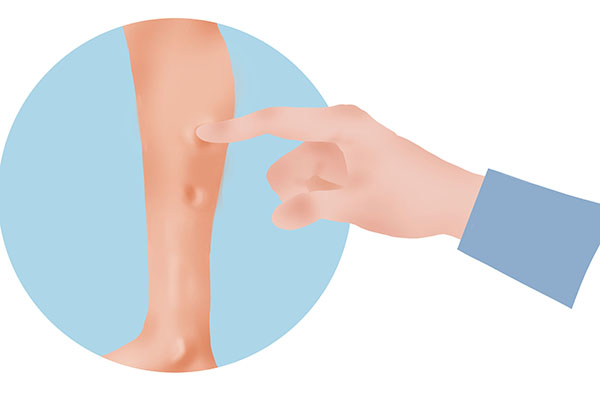 手臂粗做抽脂会反弹吗_杭州华颜医疗美容事故_医美抽脂手术风险